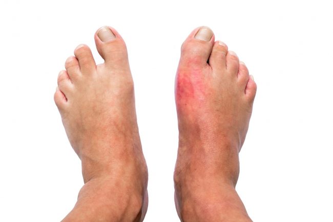 Man med svullnad och smärtsam giktinflammation i höger fot